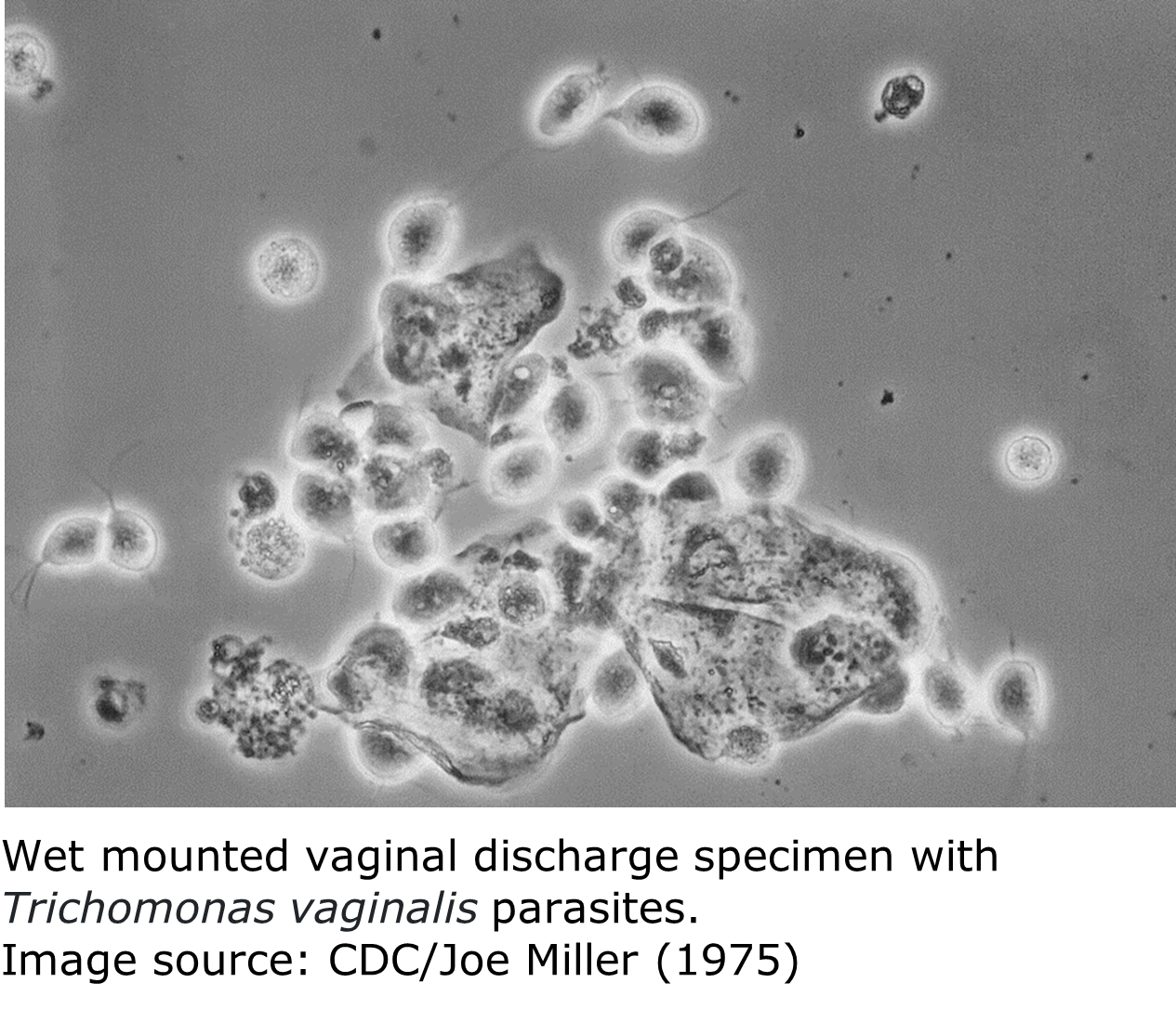 A black and white micrograph image of a vaginal discharge swab. Several grayish-white trichomonas parasites