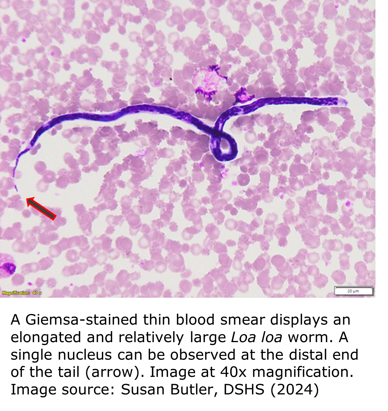 A micrograph of a blood smear showing several pinkish-stained red blood cells